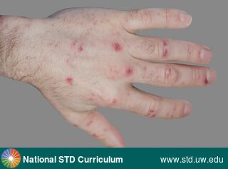 Diagnosis: Scabies, Clinical Signs: Papule / Papules, Locations: Hand (Left), Symptoms: Itch, Image Type: Photo