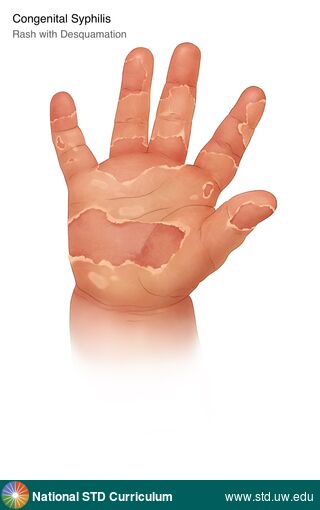 Diagnosis: Syphilis-Congenital, Clinical Signs: Desquamation, Rash, Locations: Hand (Right), Symptoms: N/A, Image Type: Illustration