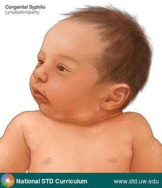 Diagnosis: Syphilis-Congenital, Clinical Signs: Adenopathy, Locations: Neck, Symptoms: Non-Painful, Image Type: Illustration