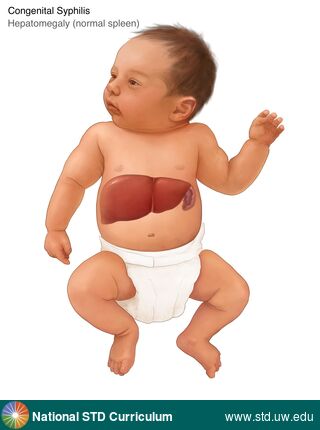 Diagnosis: Syphilis-Congenital, Clinical Signs: N/A, Locations: Abdomen, Symptoms: N/A, Image Type: Illustration