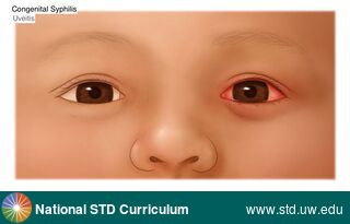 Diagnosis: Syphilis-Congenital, Clinical Signs: Erythema, Locations: Eye, Symptoms: N/A, Image Type: Illustration