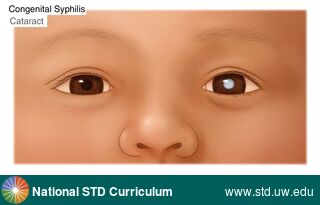 Diagnosis: Syphilis-Congenital, Clinical Signs: N/A, Locations: Eye, Symptoms: N/A, Image Type: Illustration