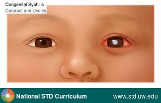 Diagnosis: Syphilis-Congenital, Clinical Signs: Erythema, Locations: Eye, Symptoms: N/A, Image Type: Illustration