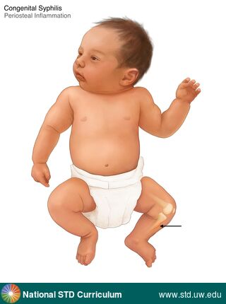 Diagnosis: Syphilis-Congenital, Clinical Signs: Edema / Swelling, Locations: Leg / Legs, Symptoms: Painful, Image Type: Illustration