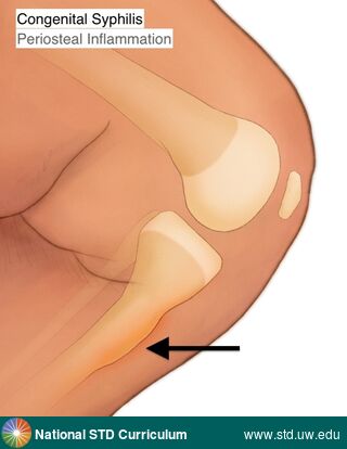 Diagnosis: Syphilis-Congenital, Clinical Signs: Edema / Swelling, Locations: Leg / Legs, Symptoms: Painful, Image Type: Illustration