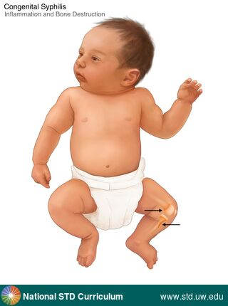 Diagnosis: Syphilis-Congenital, Clinical Signs: N/A, Locations: Leg / Legs, Symptoms: Painful, Image Type: Illustration