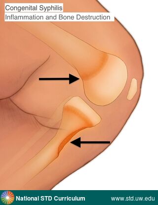 Diagnosis: Syphilis-Congenital, Clinical Signs: N/A, Locations: Leg / Legs, Symptoms: Painful, Image Type: Illustration