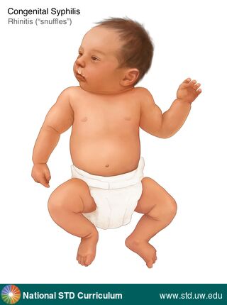 Diagnosis: Syphilis-Congenital, Clinical Signs: N/A, Locations: Face, Symptoms: N/A, Image Type: Illustration