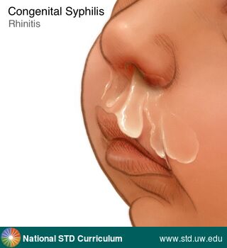 Diagnosis: Syphilis-Congenital, Clinical Signs: N/A, Locations: Face, Symptoms: N/A, Image Type: Illustration