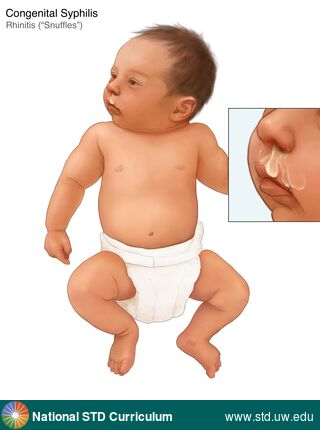 Diagnosis: Syphilis-Congenital, Clinical Signs: N/A, Locations: Face, Symptoms: N/A, Image Type: Illustration