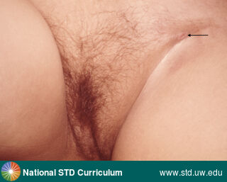 Diagnosis: Chancroid, Clinical Signs: N/A, Locations: Groin/Inguinal, Symptoms: N/A, Image Type: Photo