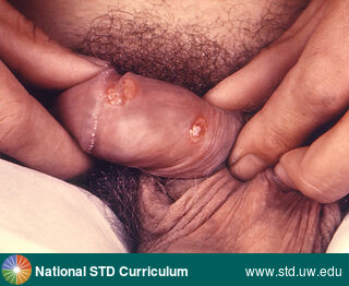Diagnosis: Chancroid, Clinical Signs: Ulcer / Ulcers, Locations: Dark skin tone, Symptoms: Painful, Image Type: Photo