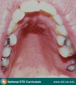 Diagnosis: Candidiasis-Oral, Clinical Signs: Erythema, Locations: Palate, Symptoms: N/A, Image Type: Photo