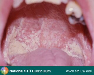 Diagnosis: Candidiasis-Oral, Clinical Signs: Patch/Patches, Plaque, Locations: Palate, Pharynx, Symptoms: N/A, Image Type: Photo