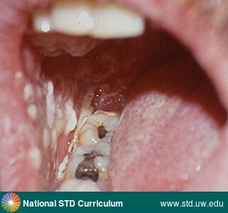 Diagnosis: Candidiasis-Oral, Clinical Signs: Patch/Patches, Plaque, Locations: Buccal mucosa, Symptoms: N/A, Image Type: Photo