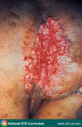 Diagnosis: Granuloma inguinale, Clinical Signs: N/A, Locations: Anal / Perianal, Dark skin tone, Symptoms: Non-Painful, Image Type: Photo