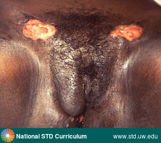 Diagnosis: Granuloma inguinale, Clinical Signs: Hypopigmentation, Ulcer / Ulcers, Locations: Dark skin tone, Groin/Inguinal, Vulva, Symptoms: Non-Painful, Image Type: Photo