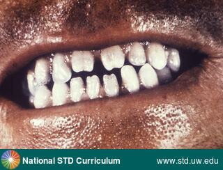 Diagnosis: Syphilis-Congenital, Clinical Signs: N/A, Locations: Dark skin tone, Teeth, Symptoms: N/A, Image Type: Photo