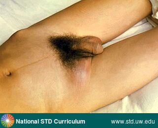 Diagnosis: Lymphogranuloma venereum, Clinical Signs: Adenopathy, Edema / Swelling, Erythema, Locations: Groin/Inguinal, Symptoms: Painful, Image Type: Photo
