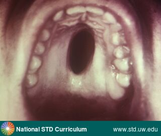 Diagnosis: Syphilis-Congenital, Clinical Signs: Lesion, Ulcer / Ulcers, Locations: Dark skin tone, Palate, Symptoms: N/A, Image Type: Photo