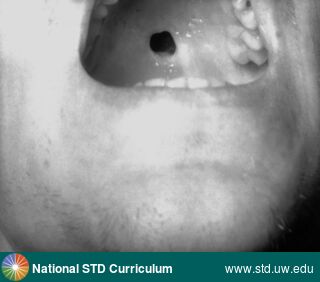 Diagnosis: Syphilis-Congenital, Clinical Signs: Ulcer / Ulcers, Locations: Palate, Symptoms: N/A, Image Type: Photo