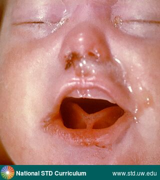 Diagnosis: Syphilis-Congenital, Clinical Signs: N/A, Locations: Face, Light skin tone, Symptoms: N/A, Image Type: Photo