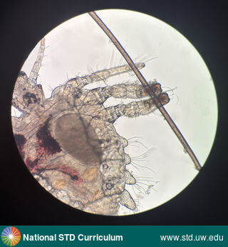 Diagnosis: Lice / Crabs, Clinical Signs: N/A, Locations: Microscope, Symptoms: Itch, Image Type: Photo