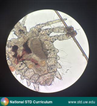 Diagnosis: Lice / Crabs, Clinical Signs: N/A, Locations: Microscope, Symptoms: Itch, Rash, Image Type: Photo