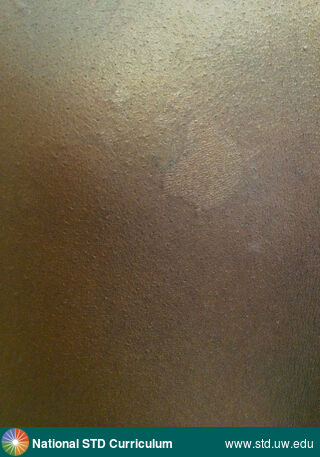 Diagnosis: Tinea versicolor, Clinical Signs: Hypopigmentation, Macule / Macules, Patch/Patches, Rash, Locations: Back, Symptoms: Non-Itchy, Non-Painful, Image Type: Photo