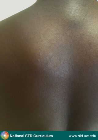 Diagnosis: Tinea versicolor, Clinical Signs: Hypopigmentation, Macule / Macules, Patch/Patches, Rash, Locations: Back, Dark skin tone, Symptoms: Non-Itchy, Non-Painful, Image Type: Photo