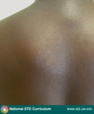 Diagnosis: Pityriasis versicolor, Clinical Signs: Hypopigmentation, Macule / Macules, Patch/Patches, Rash, Locations: Back, Dark skin tone, Symptoms: Non-Itchy, Non-Painful, Image Type: Photo