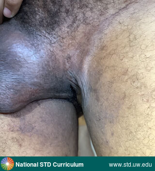 Diagnosis: Lichen simplex chronicus, Clinical Signs: Hyperpigmentation, Rash, Scale, Locations: Dark skin tone, Groin/Inguinal, Scrotum, Symptoms: Itch, Image Type: Photo