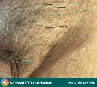 Diagnosis: Lice / Crabs, Clinical Signs: N/A, Locations: Light skin tone, Suprapubic (Hypogastrium), Symptoms: Itch, Image Type: Photo