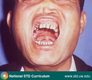 Diagnosis: Syphilis-Congenital, Clinical Signs: N/A, Locations: Nose, Teeth, Symptoms: N/A, Image Type: Photo