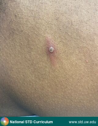 Diagnosis: Mpox, Syphilis-Secondary, Clinical Signs: N/A, Locations: Abdomen, Dark skin tone, Symptoms: N/A, Image Type: Photo
