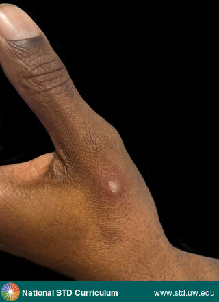 Diagnosis: Mpox, Syphilis-Secondary, Clinical Signs: Pustule / Pustules, Locations: Dark skin tone, Hand (Left), Symptoms: N/A, Image Type: Photo