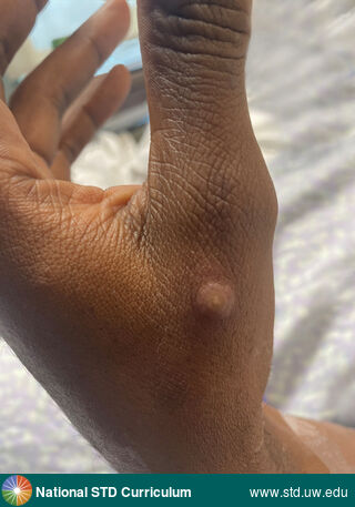 Diagnosis: Mpox, Syphilis-Secondary, Clinical Signs: Pustule / Pustules, Rash, Locations: Dark skin tone, Hand (Left), Symptoms: N/A, Image Type: Photo
