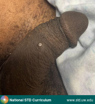 Diagnosis: Mpox, Syphilis-Secondary, Clinical Signs: Papule / Papules, Locations: Dark skin tone, Penis, Symptoms: N/A, Image Type: Photo