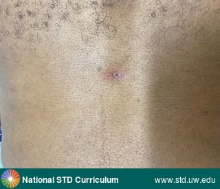 Diagnosis: Mpox, Syphilis-Secondary, Clinical Signs: Erythema, Pustule / Pustules, Locations: Chest, Dark skin tone, Symptoms: N/A, Image Type: Photo