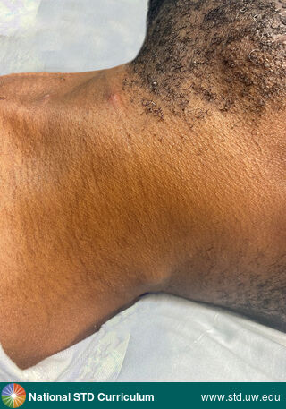 Diagnosis: Mpox, Syphilis-Secondary, Clinical Signs: Adenopathy, Nodule / Nodules, Locations: Dark skin tone, Neck, Symptoms: N/A, Image Type: Photo