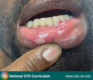 Diagnosis: Mpox, Syphilis-Secondary, Clinical Signs: N/A, Locations: Dark skin tone, Symptoms: N/A, Image Type: Photo