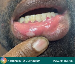 Diagnosis: Mpox, Syphilis-Secondary, Clinical Signs: N/A, Locations: Dark skin tone, Symptoms: N/A, Image Type: Photo