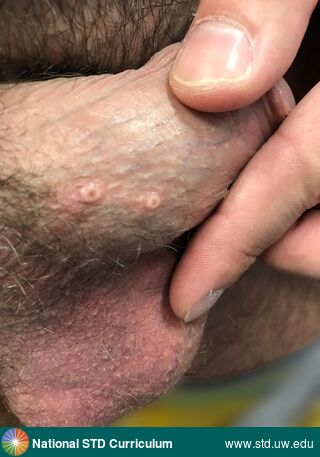 Diagnosis: Mpox, Clinical Signs: Pustule / Pustules, Locations: Light skin tone, Penis, Symptoms: Rash, Image Type: Photo
