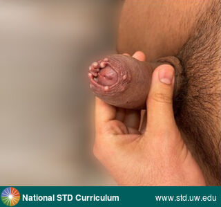 Diagnosis: Mpox, Clinical Signs: Pustule / Pustules, Locations: Light skin tone, Penis, Symptoms: Painful, Image Type: Photo