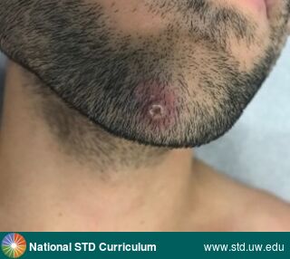 Diagnosis: Mpox, Clinical Signs: Pustule / Pustules, Locations: Face, Light skin tone, Symptoms: Rash, Image Type: Photo