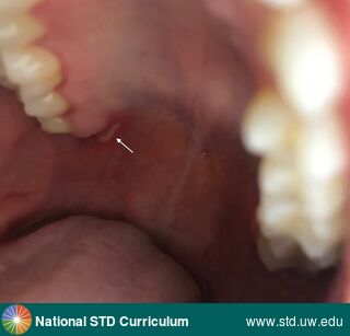 Diagnosis: Mpox, Clinical Signs: Ulcer / Ulcers, Locations: Light skin tone, Palate, Symptoms: Painful, Image Type: Photo