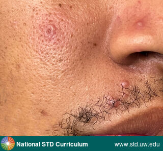 Diagnosis: Mpox,  Clinical Signs: Papule / Papules, Vesicle / Vesicles,  Locations: Dark skin tone, Face, Symptoms: Painful,  Image Type: Photo