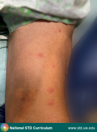 Diagnosis: Mpox,  Clinical Signs: Macule / Macules, Papule / Papules, Vesicle / Vesicles,  Locations: Dark skin tone, Symptoms: N/A,  Image Type: Photo