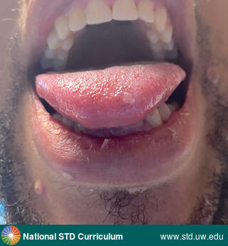 Diagnosis: Mpox,  Clinical Signs: Plaque, Pustule / Pustules, Vesicle / Vesicles,  Locations: Dark skin tone, Lips, Tongue, Symptoms: Painful,  Image Type: Photo