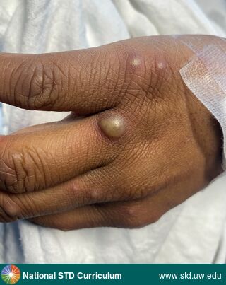 Diagnosis: Mpox,  Clinical Signs: Bulla / Bullae, Pustule / Pustules, Vesicle / Vesicles,  Locations: Dark skin tone, Hand (Left), Symptoms: Painful,  Image Type: Photo